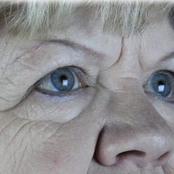 Brow Lift Before & After Patient #75