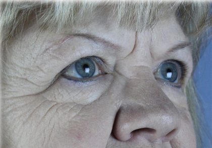 Brow Lift Before & After Patient #75