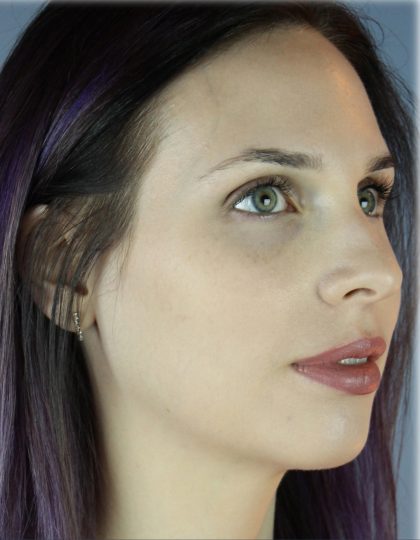 Chin Augmentation Before & After Patient #96
