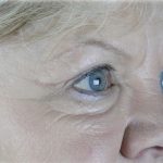 Brow Lift Before & After Patient #75