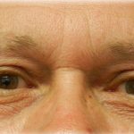 Upper Blepharoplasty Before & After Patient #125