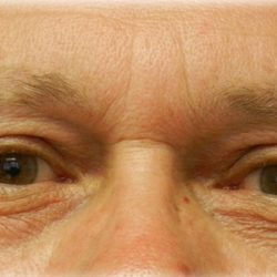 Upper Blepharoplasty Before & After Patient #125