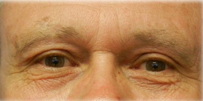 Upper Blepharoplasty Before & After Patient #125