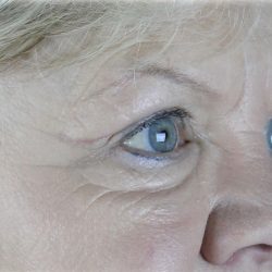 Brow Lift Before & After Patient #75