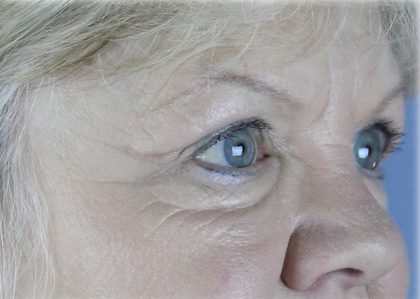 Brow Lift Before & After Patient #75