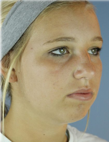 Chin Augmentation Before & After Patient #83