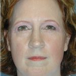 Brow Lift Before & After Patient #76