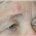 Upper Blepharoplasty Before & After Patient #126