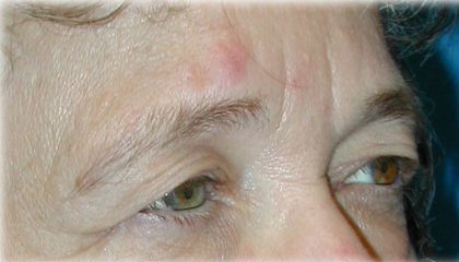 Upper Blepharoplasty Before & After Patient #126