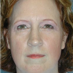 Brow Lift Before & After Patient #76