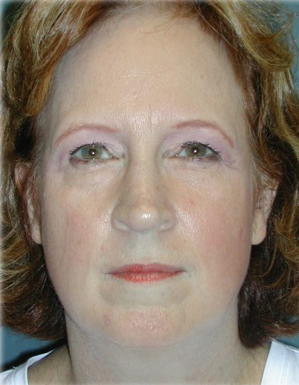 Brow Lift Before & After Patient #76