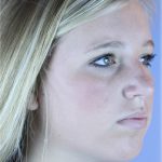 Chin Augmentation Before & After Patient #83