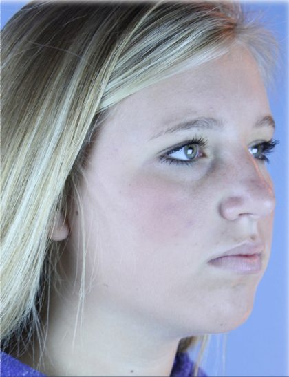 Chin Augmentation Before & After Patient #83
