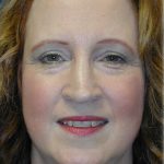 Brow Lift Before & After Patient #76