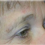 Upper Blepharoplasty Before & After Patient #126