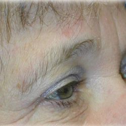 Upper Blepharoplasty Before & After Patient #126