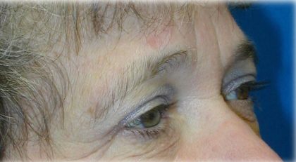 Upper Blepharoplasty Before & After Patient #126