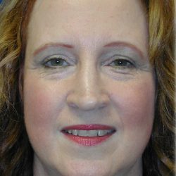Brow Lift Before & After Patient #76