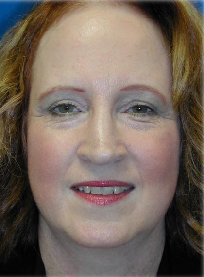 Brow Lift Before & After Patient #76