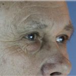 Lower Blepharoplasty Before & After Patient #127