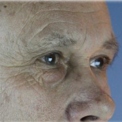 Lower Blepharoplasty Before & After Patient #127