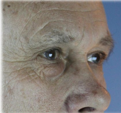Lower Blepharoplasty Before & After Patient #127