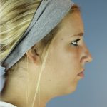 Chin Augmentation Before & After Patient #83
