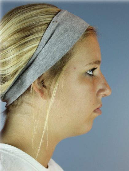 Chin Augmentation Before & After Patient #83