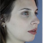 Neck Liposuction Before & After Patient #5321