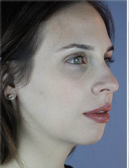 Neck Liposuction Before & After Patient #5321