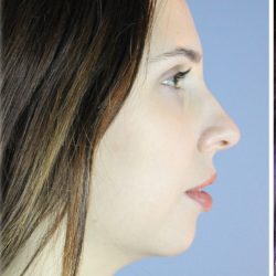 Neck Liposuction Before & After Patient #5321