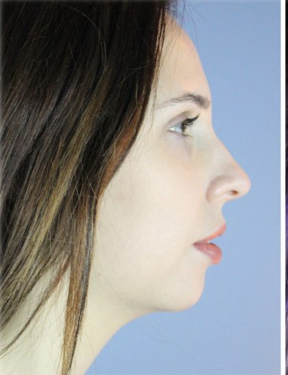 Neck Liposuction Before & After Patient #5321