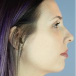 Neck Liposuction Before & After Patient #5321
