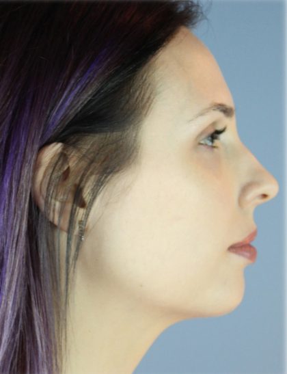 Neck Liposuction Before & After Patient #5321