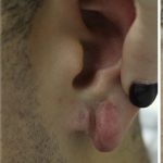 Earlobe Repair Before & After Patient #6261