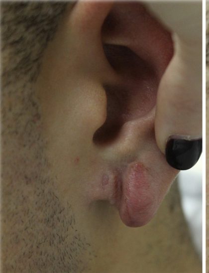 Earlobe Repair Before & After Patient #6261