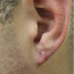 Earlobe Repair Before & After Patient #6261