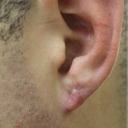 Earlobe Repair Before & After Patient #6261