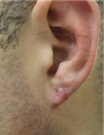 Earlobe Repair Before & After Patient #6261