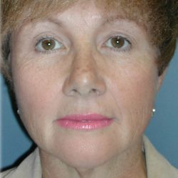 QuickLift Before & After Patient #5579
