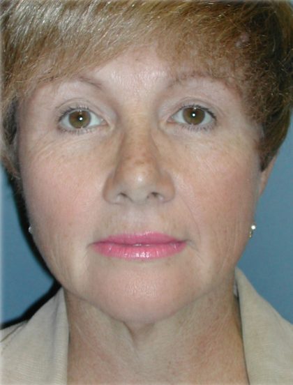 QuickLift Before & After Patient #5579