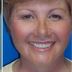 QuickLift Before & After Patient #5579