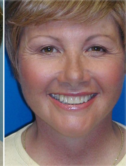 QuickLift Before & After Patient #5579