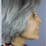 QuickLift Before & After Patient #5591