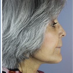 QuickLift Before & After Patient #5591