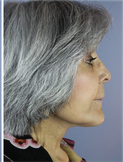 QuickLift Before & After Patient #5591