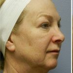 QuickLift Before & After Patient #5614