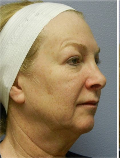 QuickLift Before & After Patient #5614