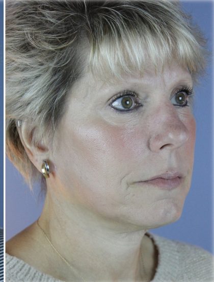 QuickLift Before & After Patient #5622