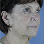 QuickLift Before & After Patient #5633